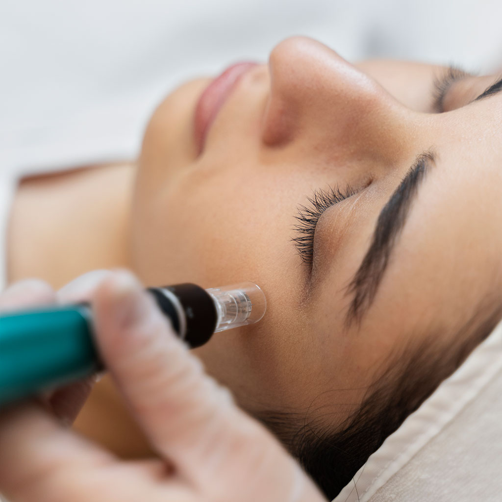 Microneedling