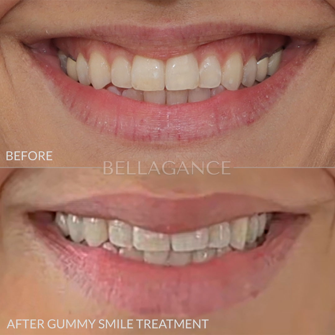 Lip Flip and Gummy Smile Treatment